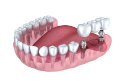 dental implant secured bridge manassas va dental implant services 